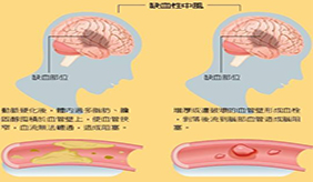 专家提醒：脑血栓和脑栓塞不是一回事