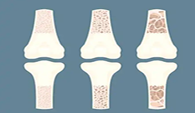 为什么骨质疏松症找上了年轻人呢?如何防治骨质疏松?